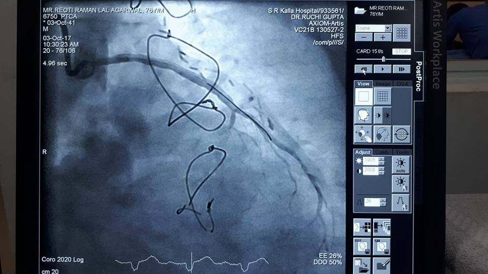 The vessel after angioplasty and stenting