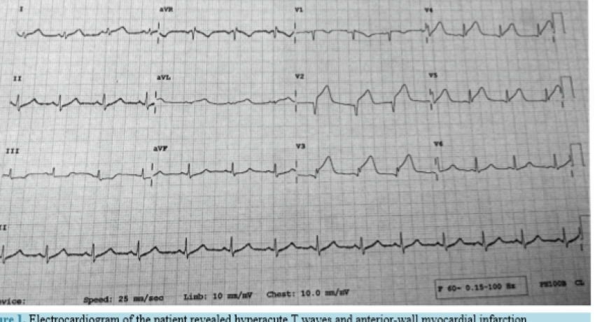 ECG of a pregnant lady with Acute Heart Attack