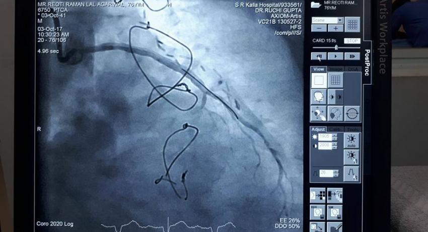 After angioplasty and stenting