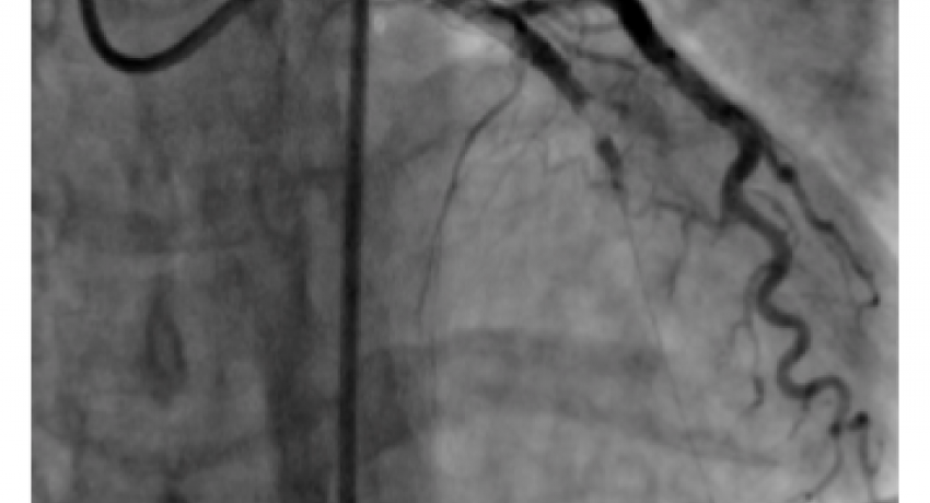 Angiography showing 100% blocked Coronary Artery