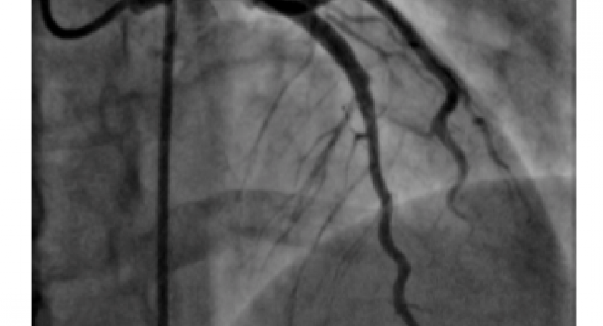 Image after Thrombus removal and angioplasty