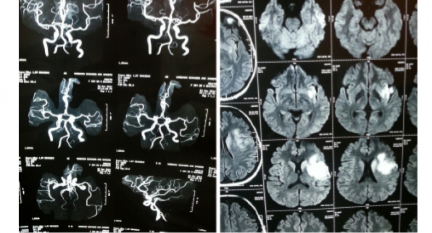 Brain scan showing Infarct